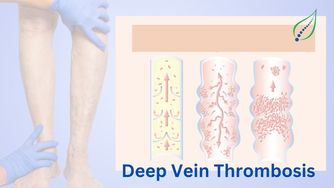 Deep Vein Thrombosis